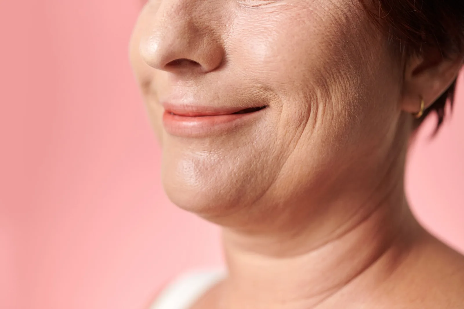 Close-up of the lower face and jawline of a mature woman showing skin laxity